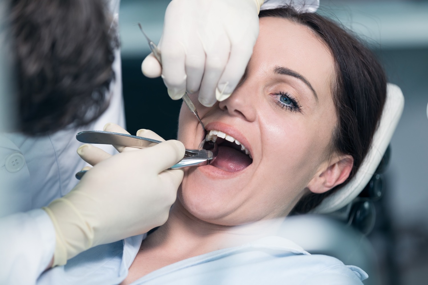Tooth Extraction Cosmocare Dubai