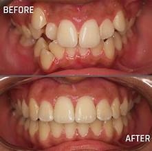 Tooth Extraction Before and After